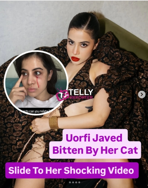Shocking Picture on Instagram: The Iconic Celebrity Drops an Injured Picture on Social Media; Find Out What Actually Happened to Uorfi Javed;